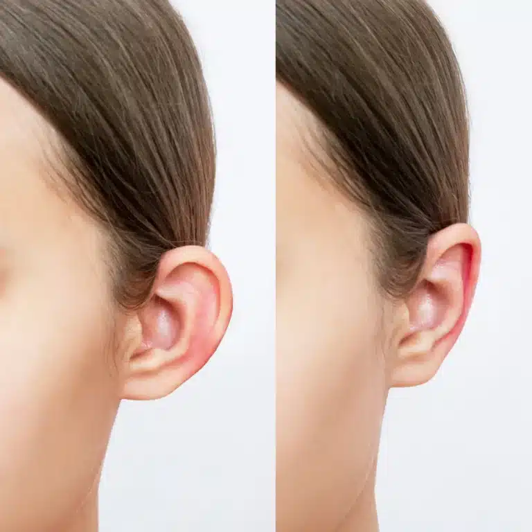 Comparativo antes e depois de uma otoplastia mostrando a correção da orelha de abano e o resultado estético natural após a cirurgia.