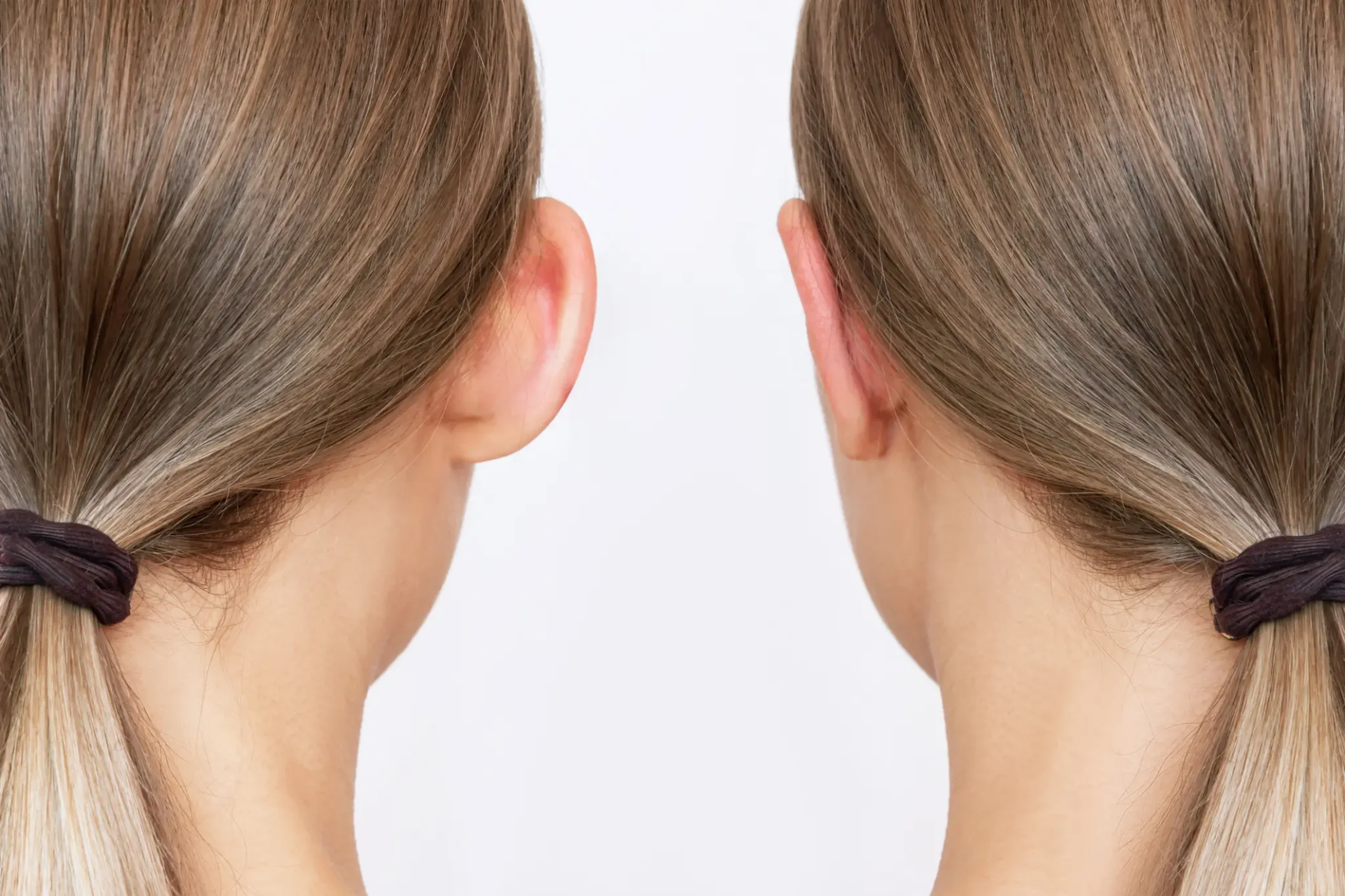 Comparação entre uma orelha com projeção aumentada e outra com formato mais alinhado, ilustrando assimetrias auriculares e deformidades da orelha.