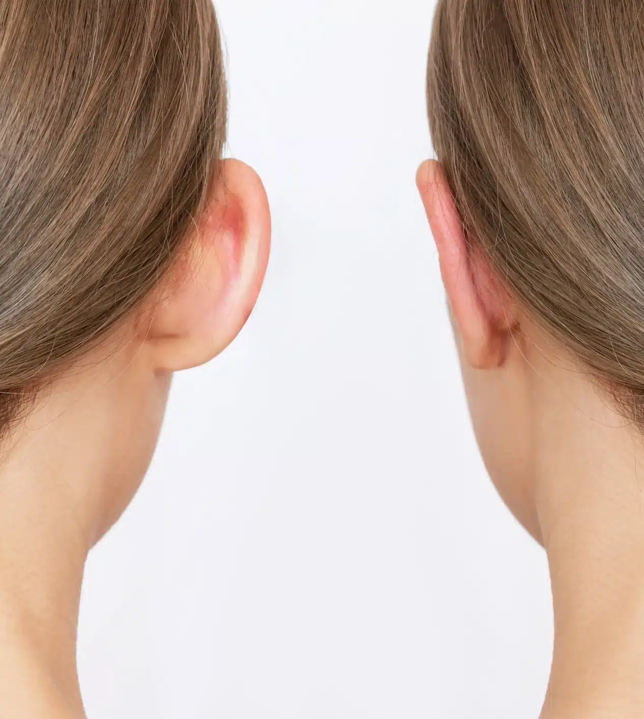 Comparação entre uma orelha com projeção aumentada e outra com formato mais alinhado, ilustrando assimetrias auriculares e deformidades da orelha.